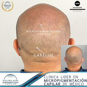 tatuaje vs micropigmentacion capilar