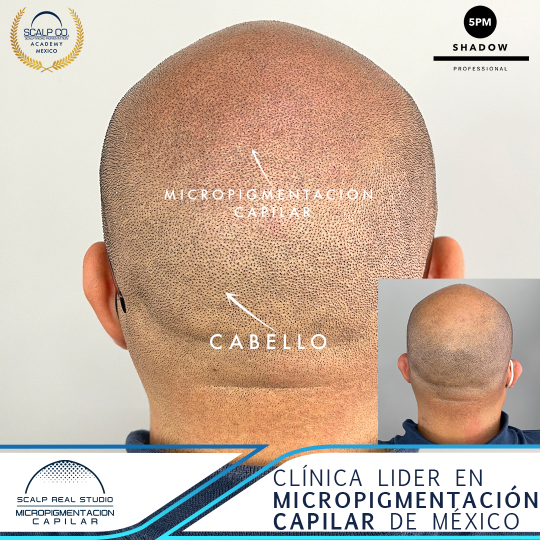 tatuaje vs micropigmentacion capilar