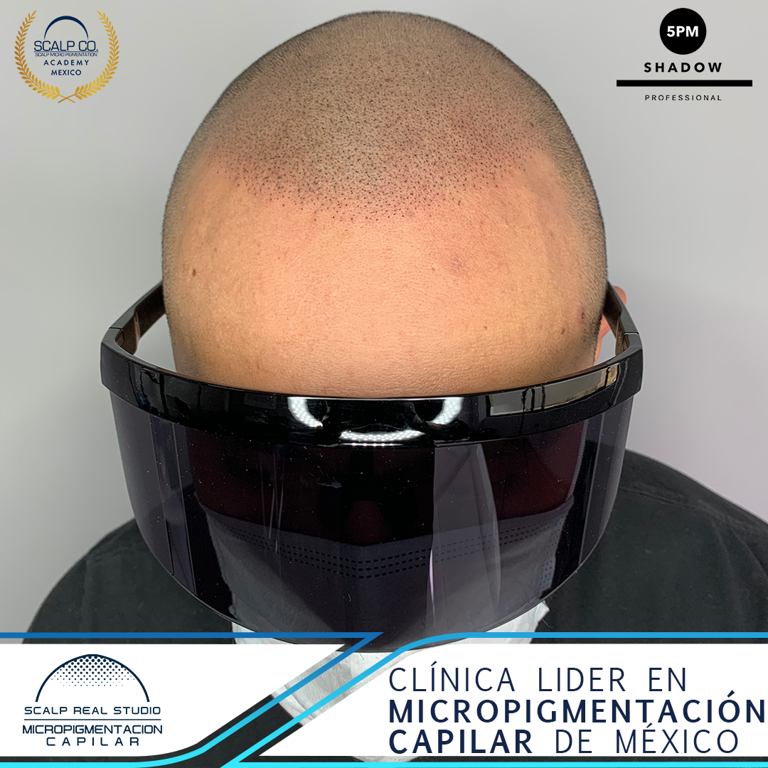 micropigmentacion capilar sesion final