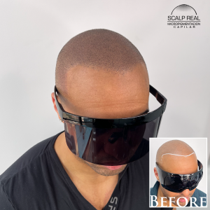 scalp micropigmentation in polanco ciudad de mexico