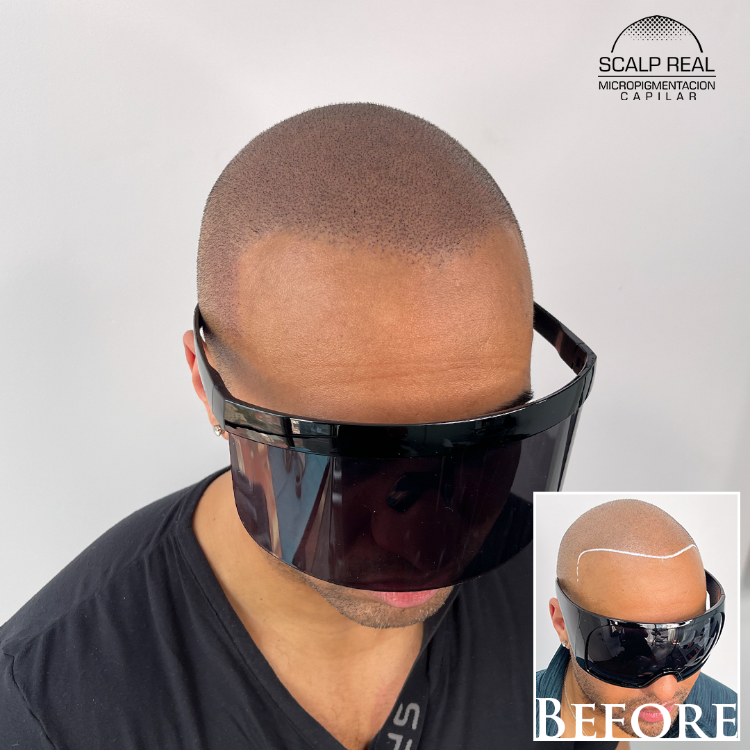 scalp micropigmentation in polanco ciudad de mexico