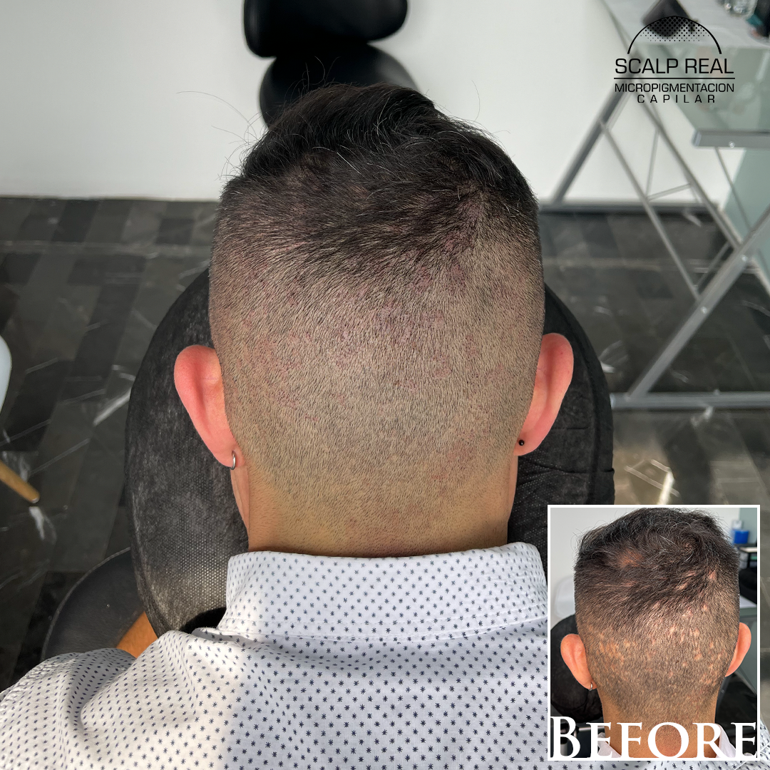 micropigmentacion capilar camuflaje de alopecia areata en ciudad de mexico