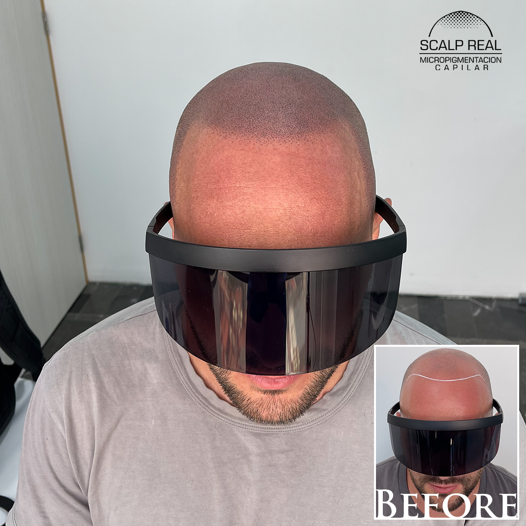 scalp micropigmentation in polanco mexico city