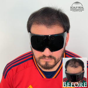 micropigmentacion capilar densidad polanco cdmx