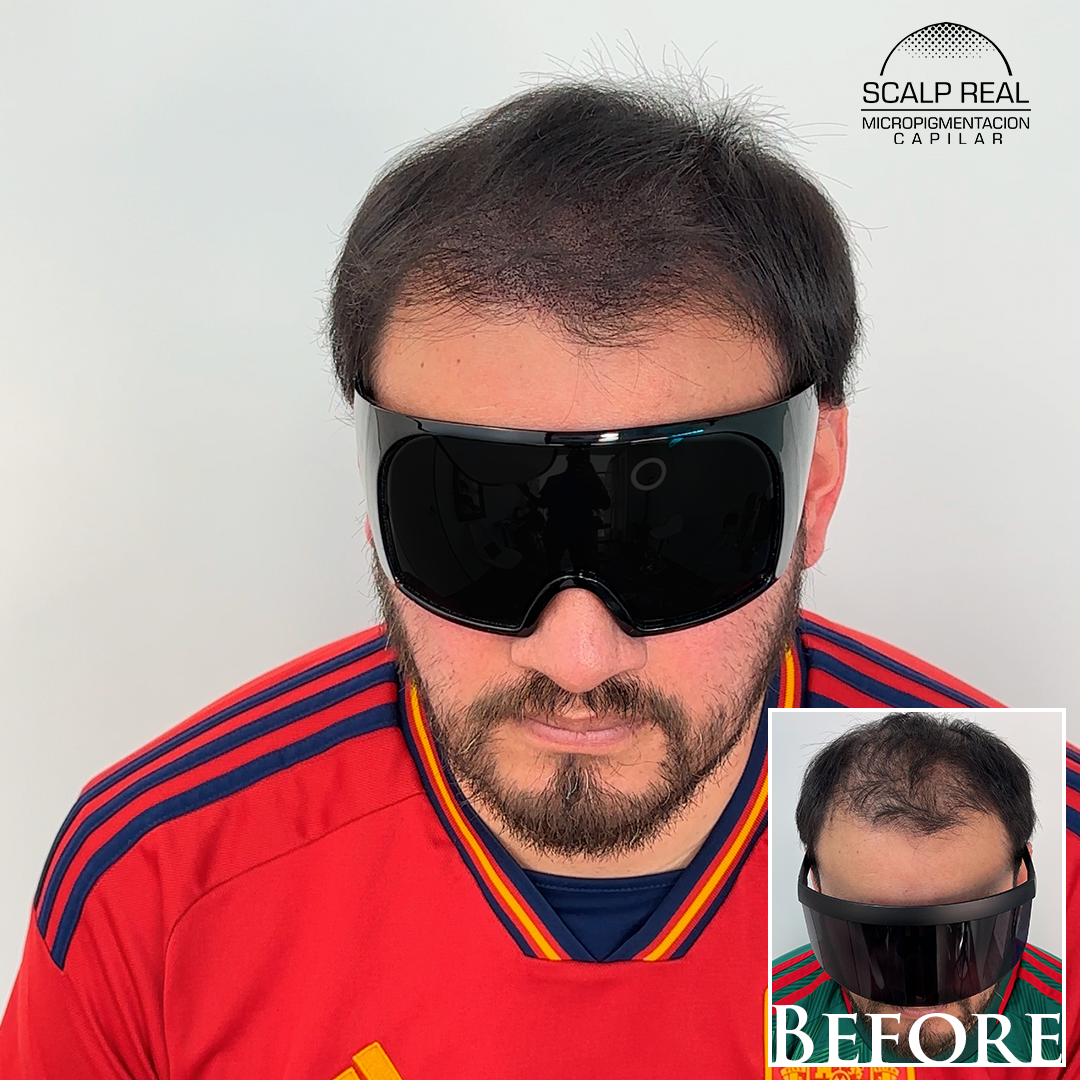 micropigmentacion capilar densidad polanco cdmx