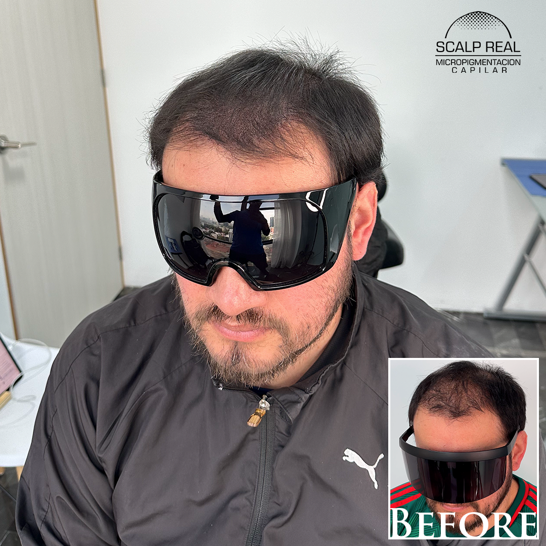 micropigmentacion capilar densidad polanco cdmx