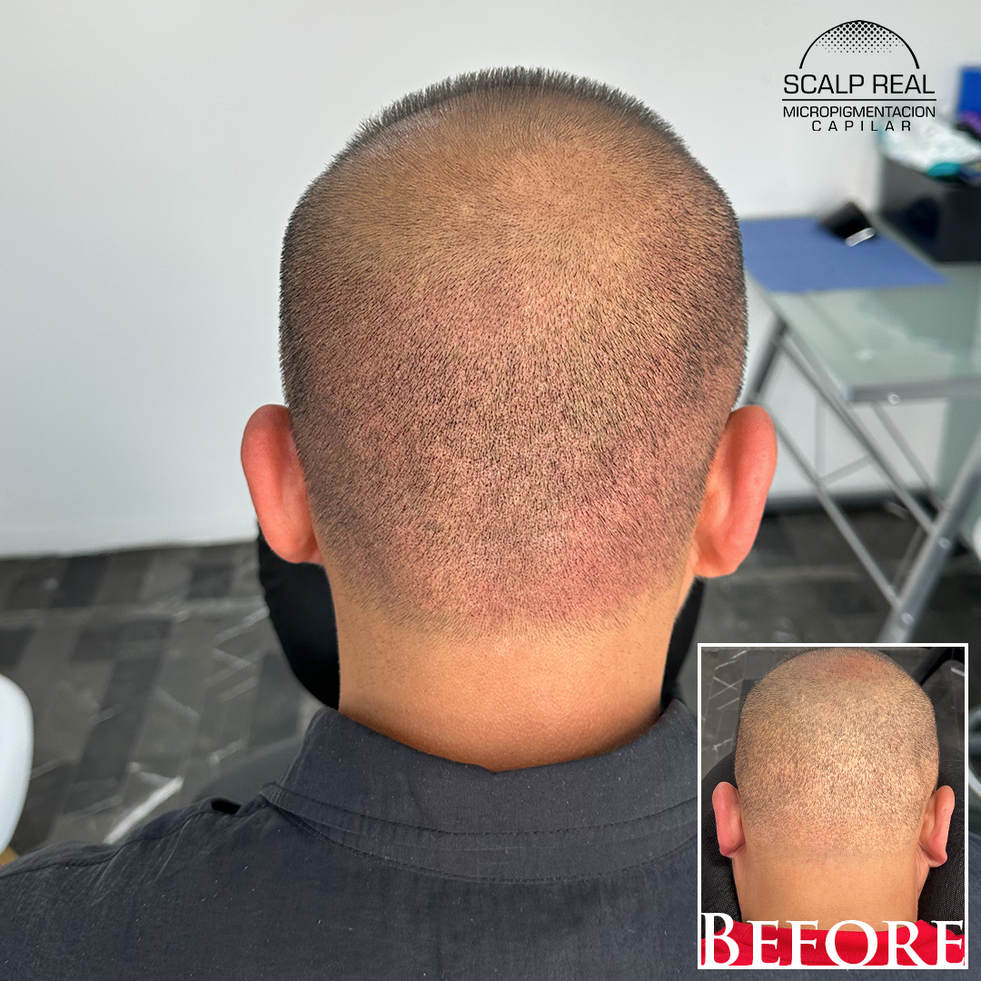 micropigmentacion capilar cicatrices polanco cdmx