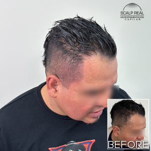 micropigmentacion capilar alopecia