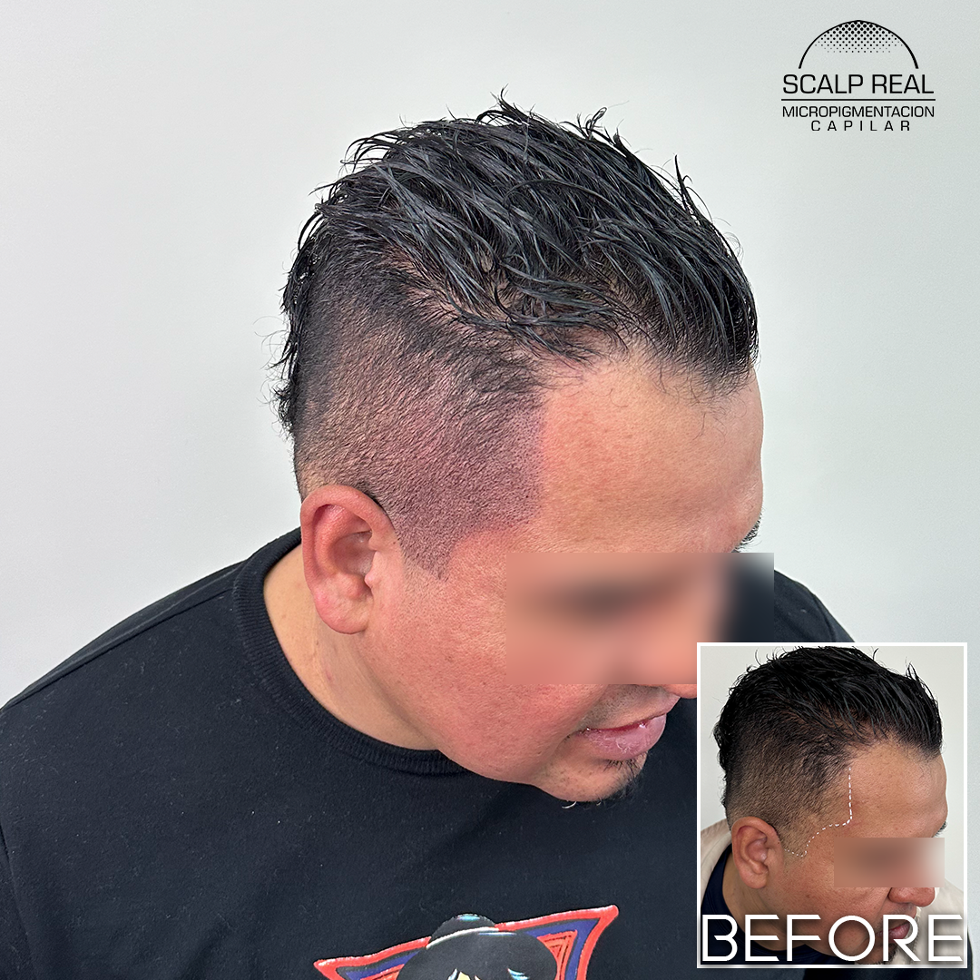 micropigmentacion capilar alopecia