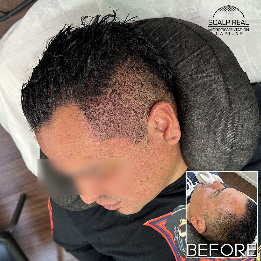 micropigmentacion capilar alopecia