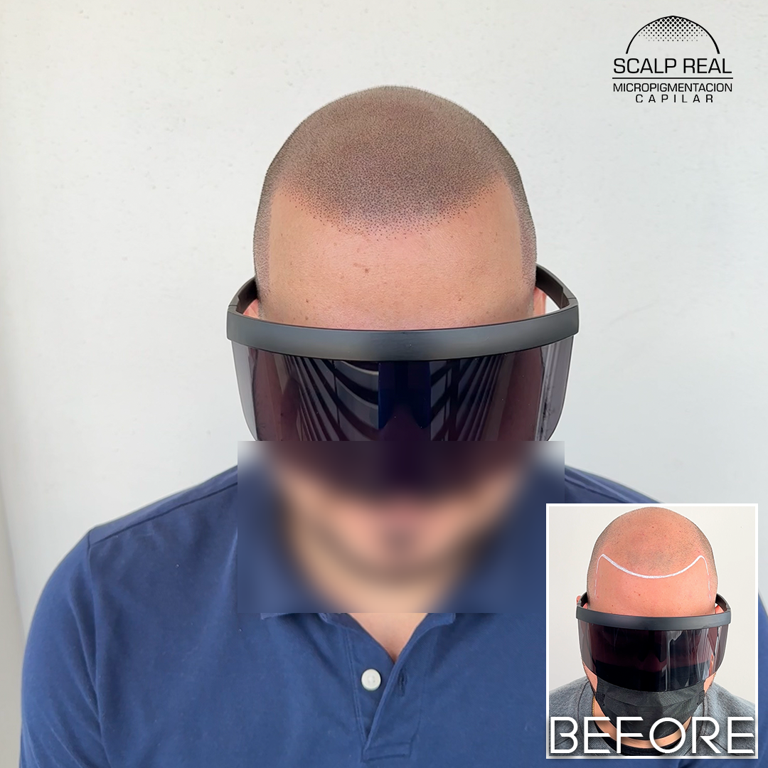 micropigmentacion capilar efecto rapado 1