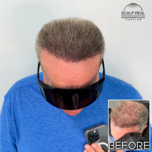 micropigmentacion capilar canas