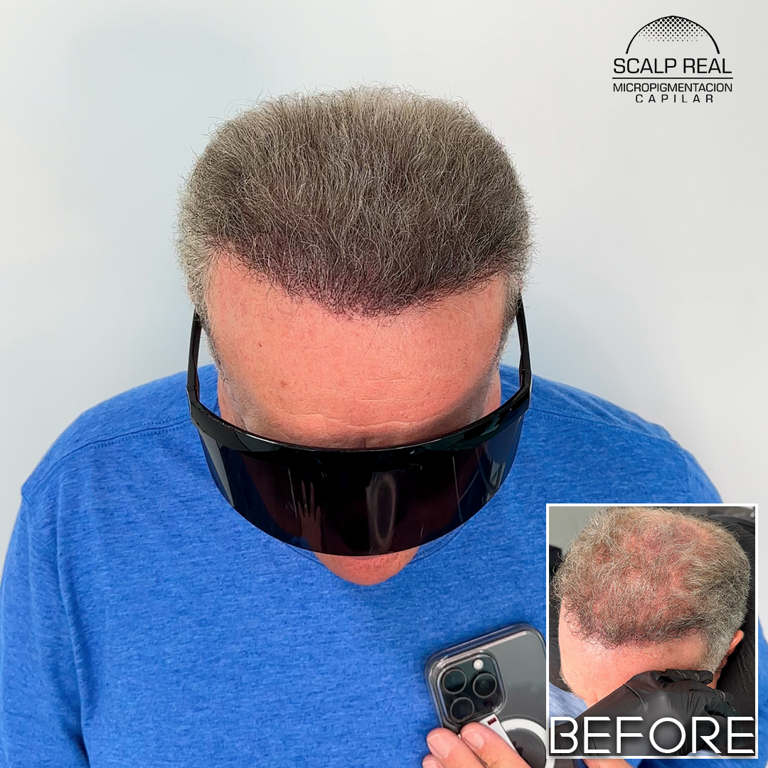 micropigmentacion capilar canas
