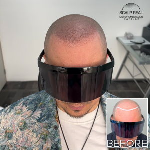 scalp micropigmentation tijuana