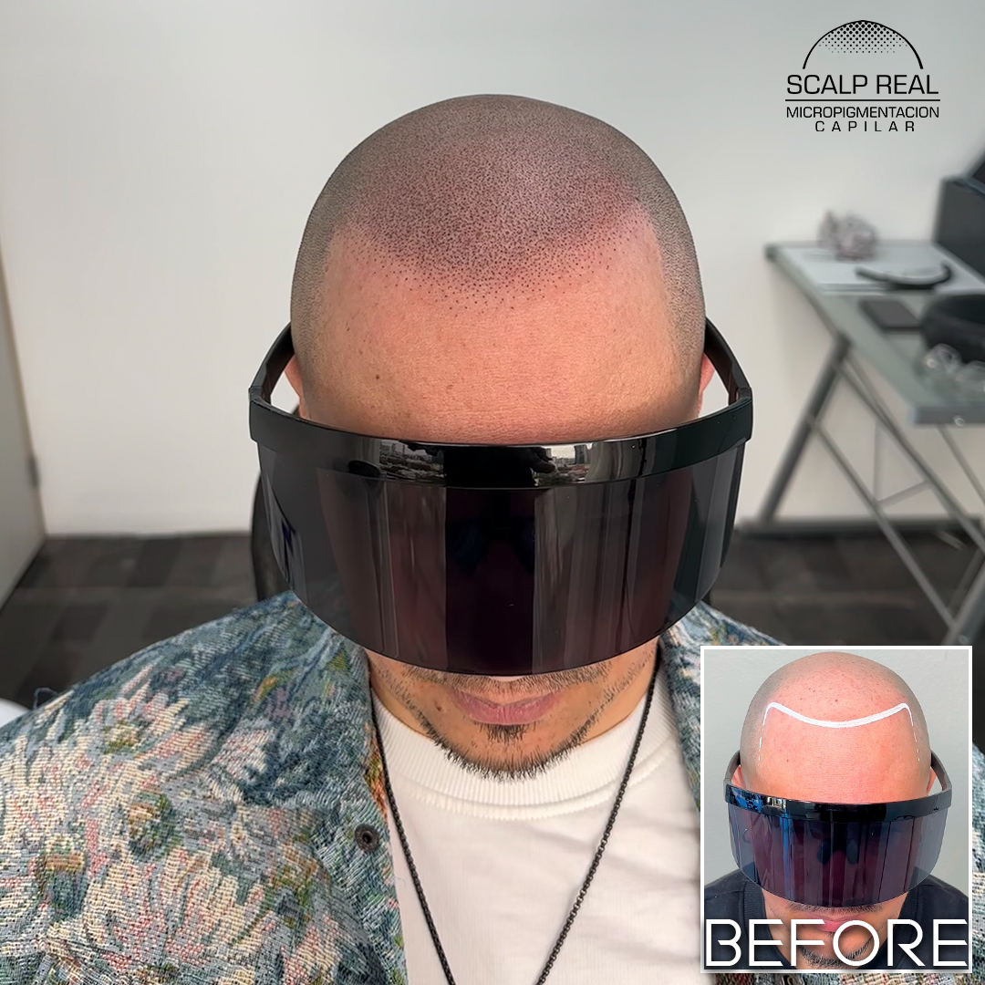 scalp micropigmentation tijuana
