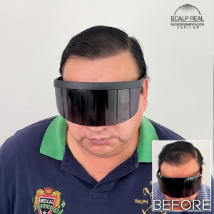 micropigmentacion capilar polanco