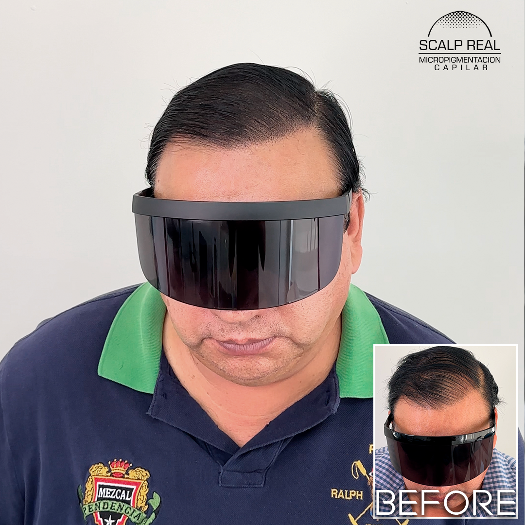 micropigmentacion capilar polanco
