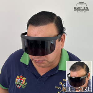 micropigmentacion capilar polanco