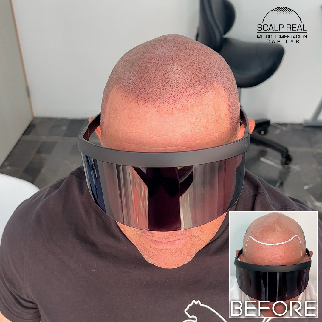 scalp micropigmentacion mexico