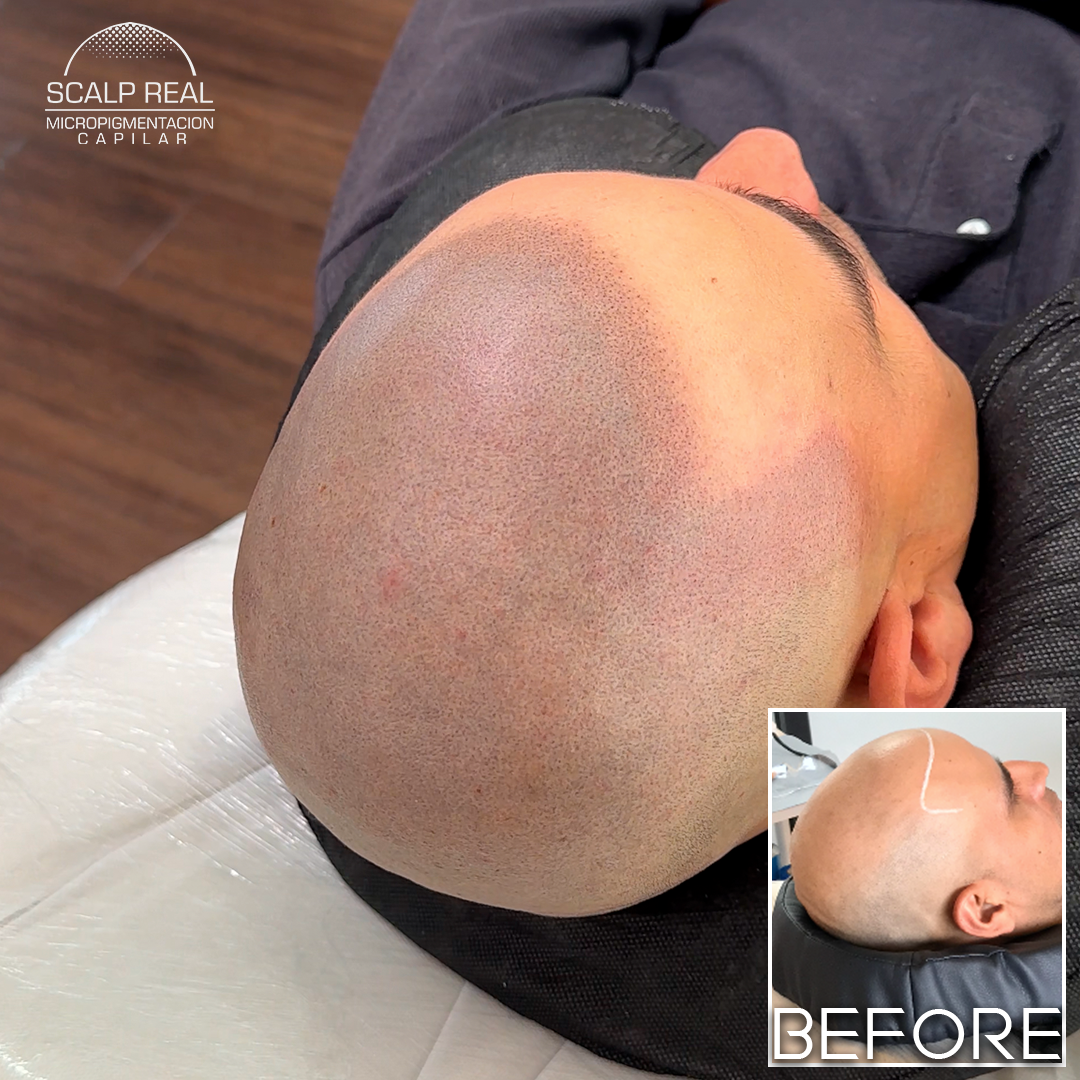 scalp mexico