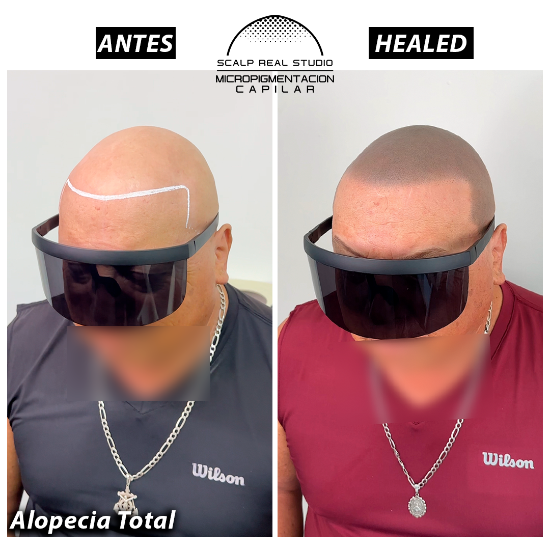 micropigmentacion capilar alopecia total