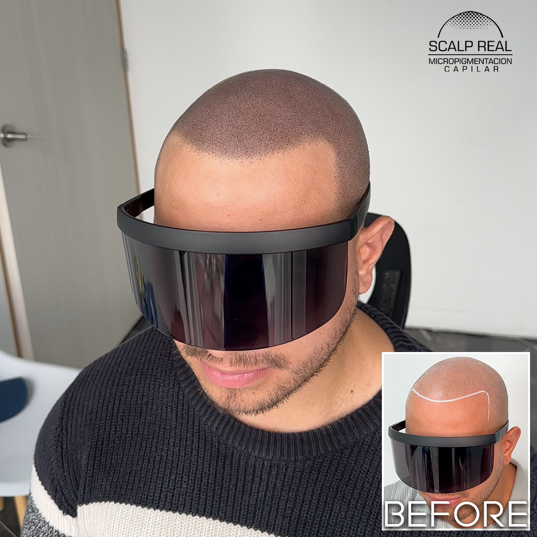 scalp mexico