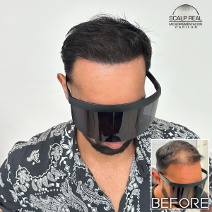 scalp micropigmentacion mexico city