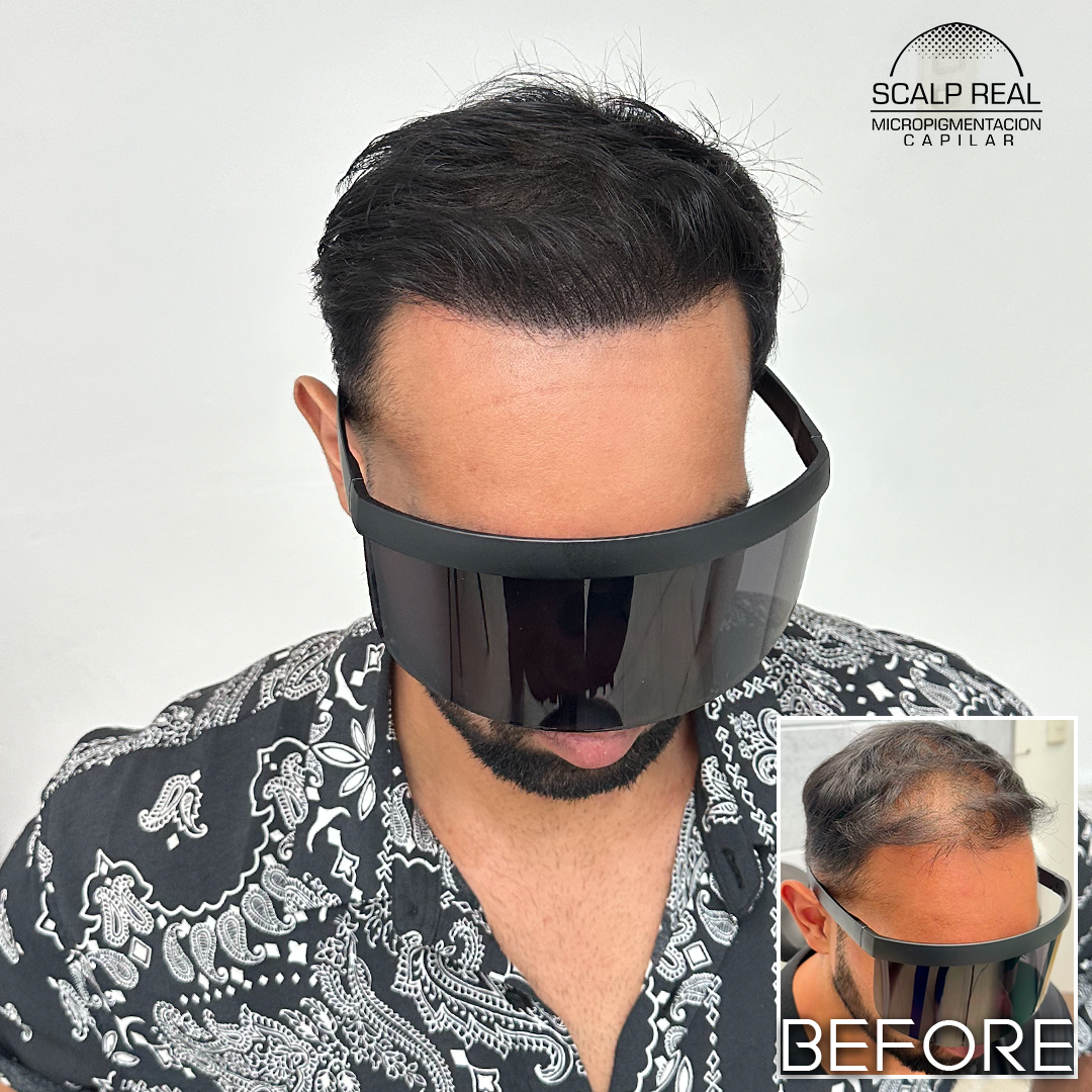scalp micropigmentacion mexico city