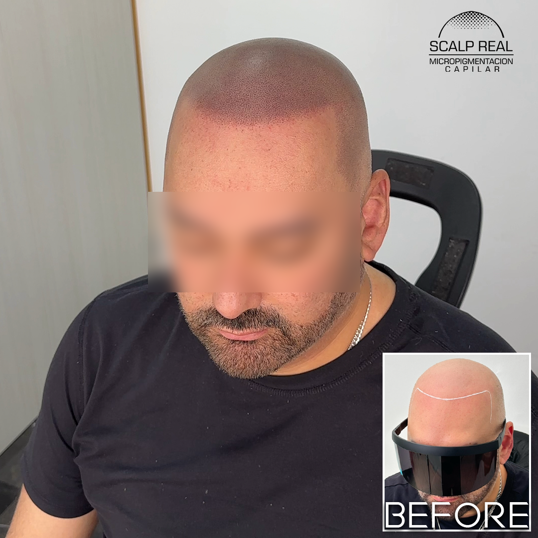 scalp micropigmentation cdmx