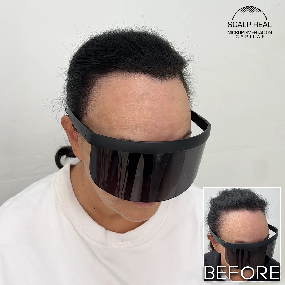 micropigmentacion capilar densidad mujer