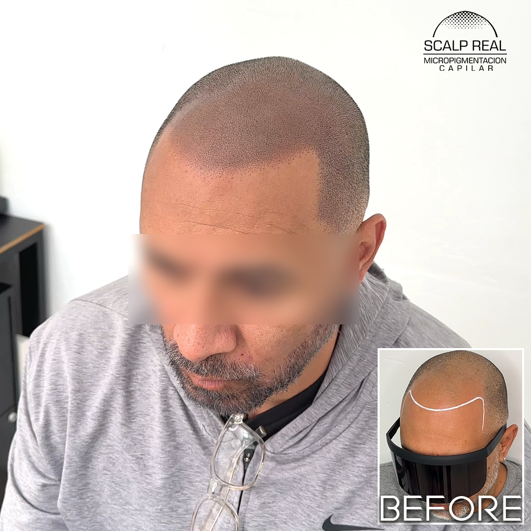 micropigmentacion capilar efecto rapado