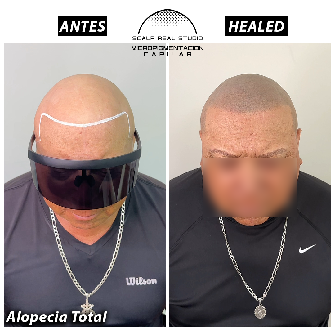 tratamiento para alopecia total