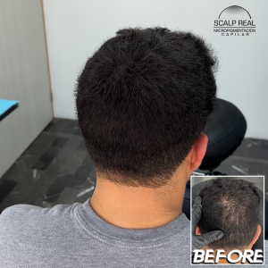 scalp polanco densidad