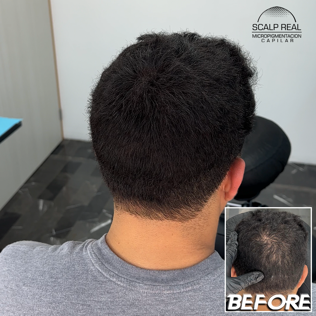 scalp polanco densidad