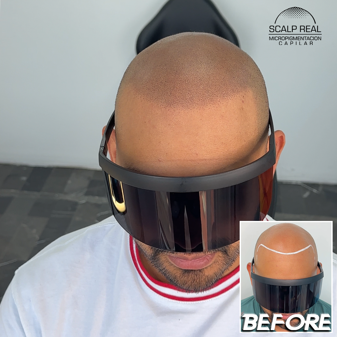 scalp polanco