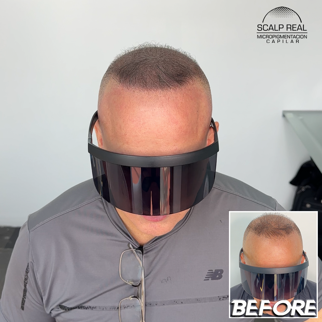 micropigmentacion capilar canas