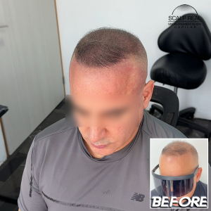 micropigmentacion capilar canas