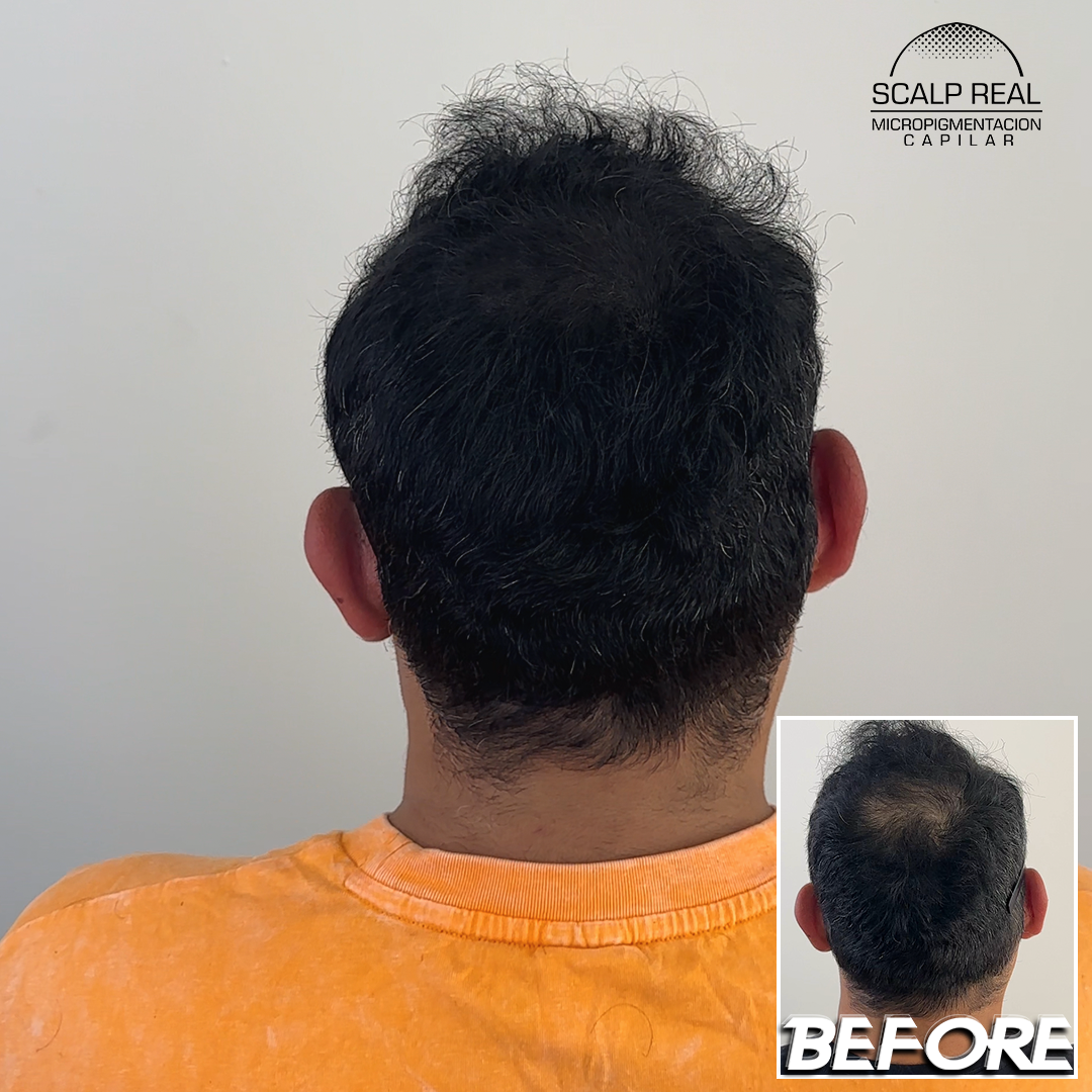 micropimentacion capilar coronilla